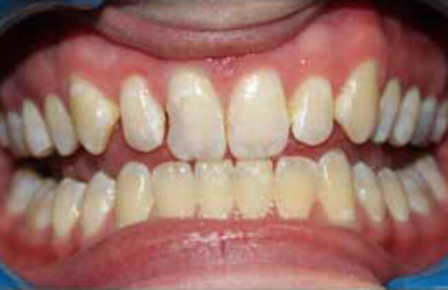 Before (Teeth)