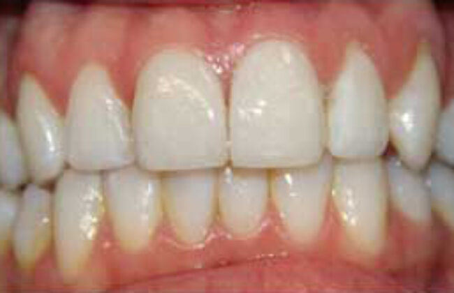 After (Teeth)