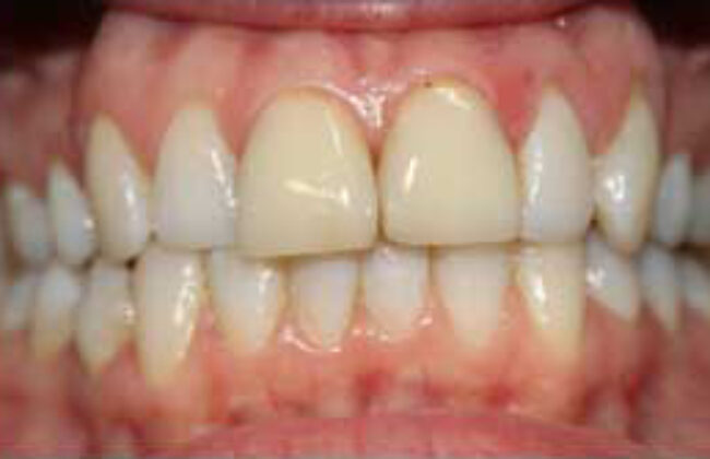 Before (Teeth)