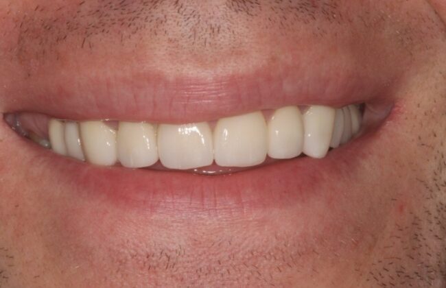 After (Teeth)