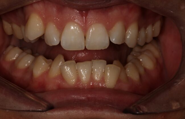 Before (Teeth)