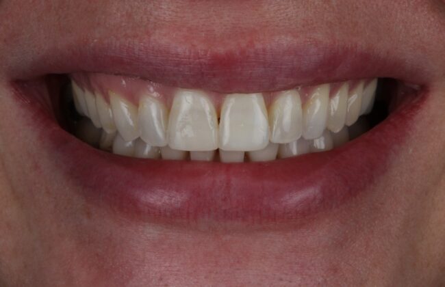 After (Teeth)