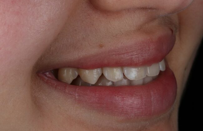 After (Teeth)