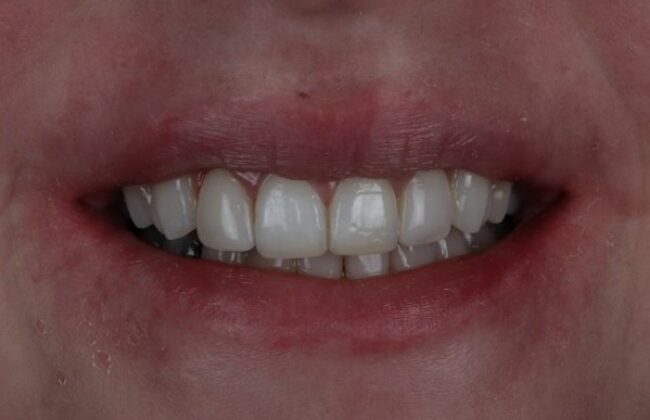 After (Teeth)