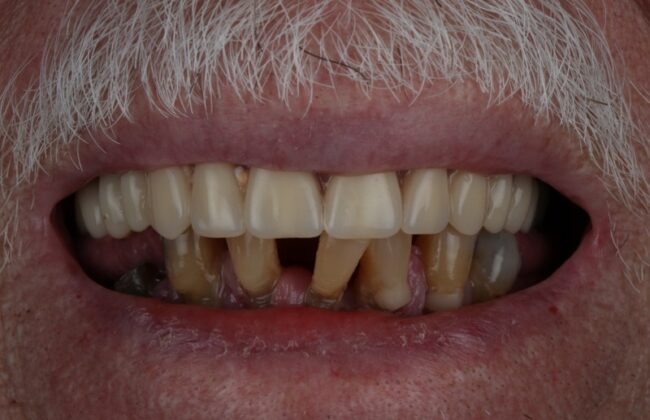 Before (Teeth)