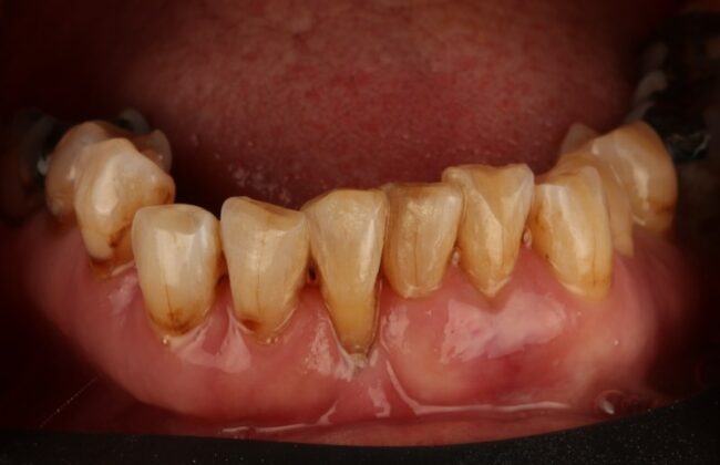 After (Teeth)