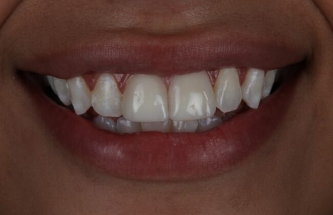 After (Teeth)