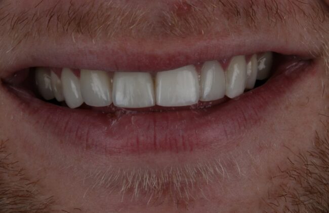 After (Teeth)