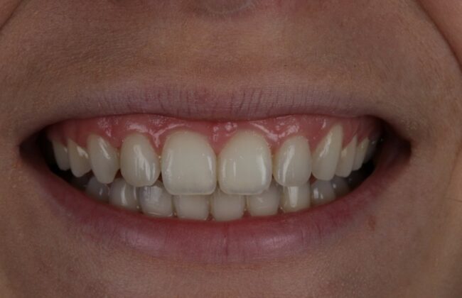 Before (Teeth)