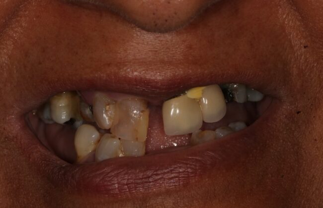 Before (Teeth)
