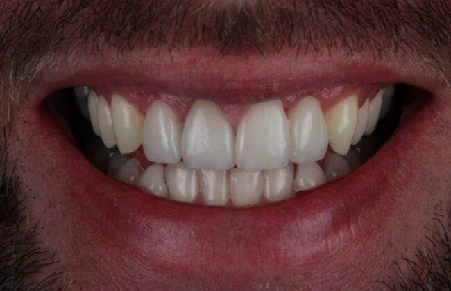 After (Teeth)