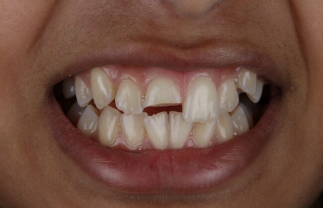 Before (Teeth)