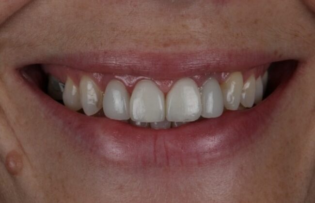 After (Teeth)