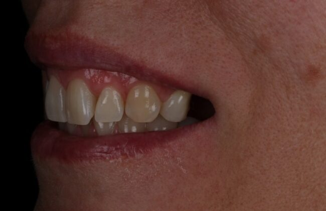 Before (Teeth)