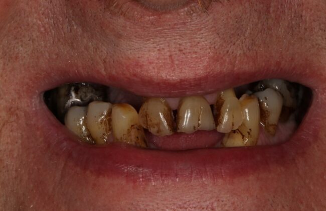 Before (Teeth)
