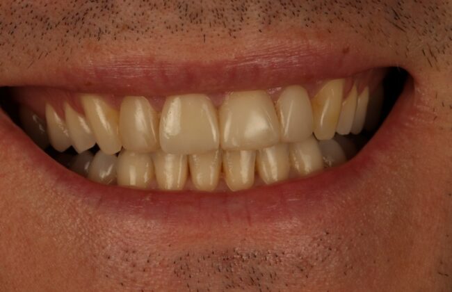 After (Teeth)