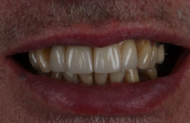 After (Teeth)