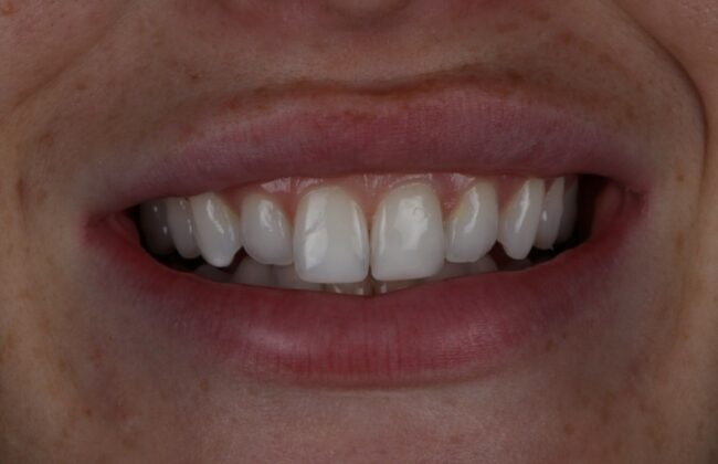 After (Teeth)