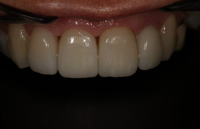 After (Teeth)
