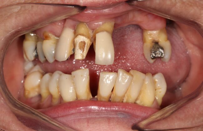 Before (Teeth)