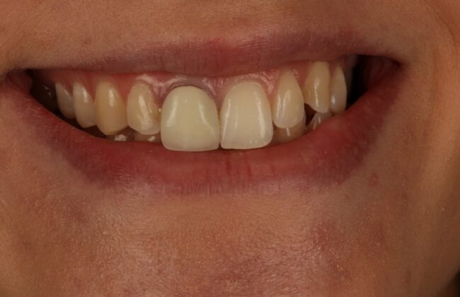 Before (Teeth)