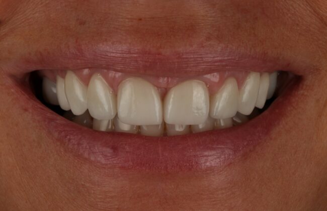 After (Teeth)