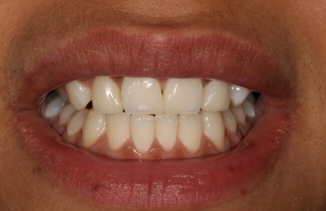 After (Teeth)