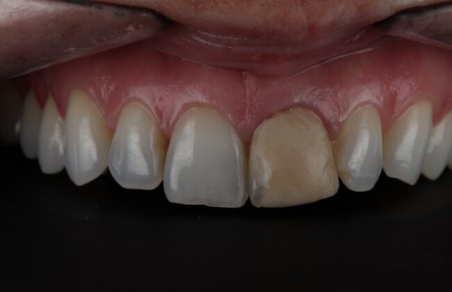 Before (Teeth)