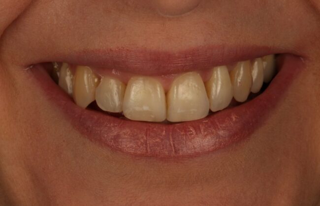 After (Teeth)