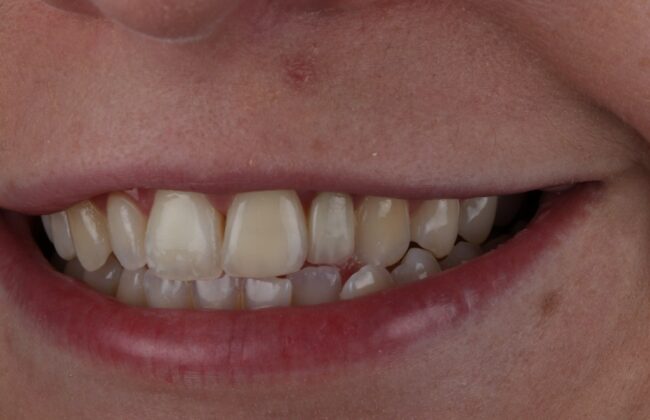 After (Teeth)