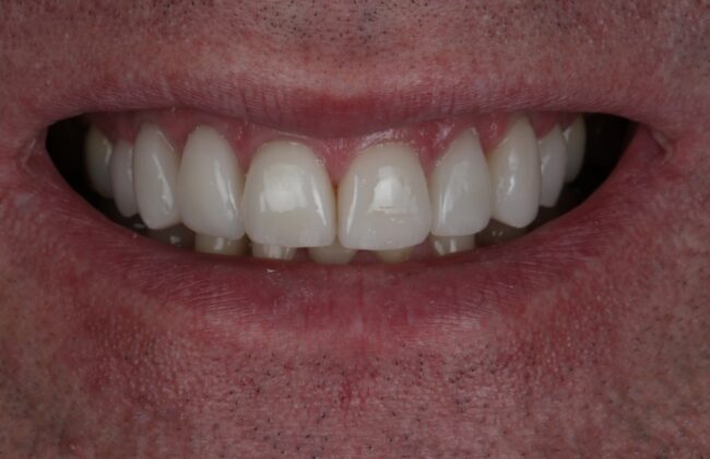 After (Teeth)