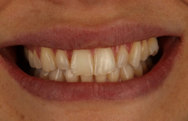 Before (Teeth)