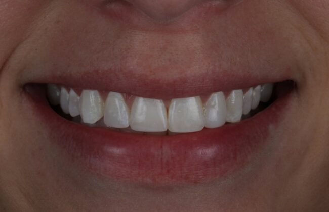 After (Teeth)