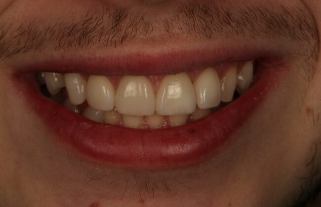 After (Teeth)