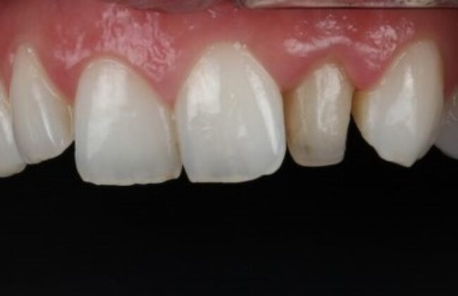 Before (Teeth)