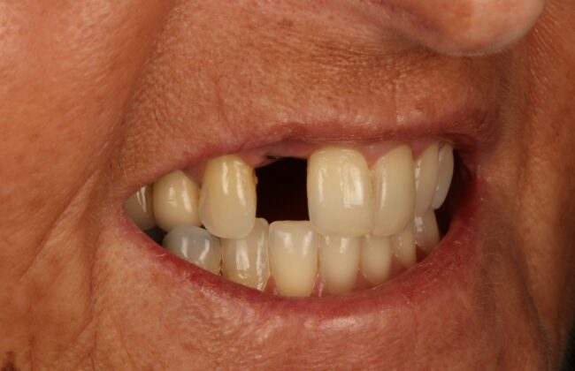 Before (Teeth)