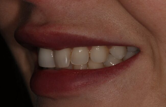 Before (Teeth)
