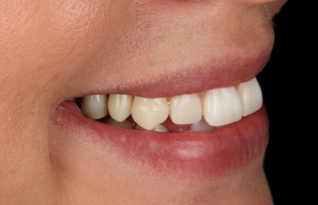 After (Teeth)