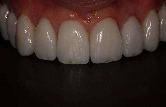 After (Teeth)