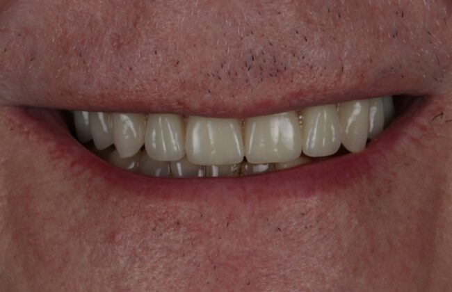 After (Teeth)