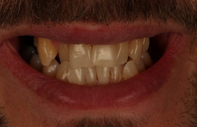 Before (Teeth)