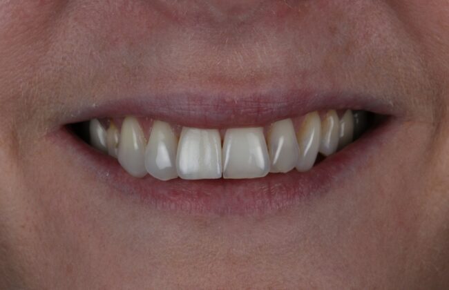 After (Teeth)