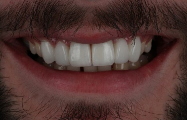 After (Teeth)