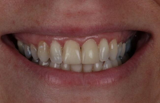 After (Teeth)