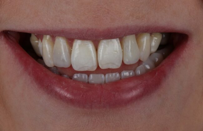 After (Teeth)
