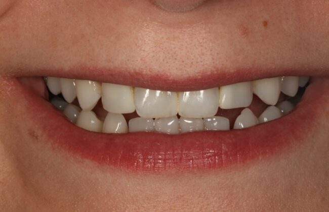 After (Teeth)
