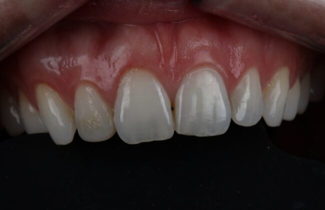Before (Teeth)