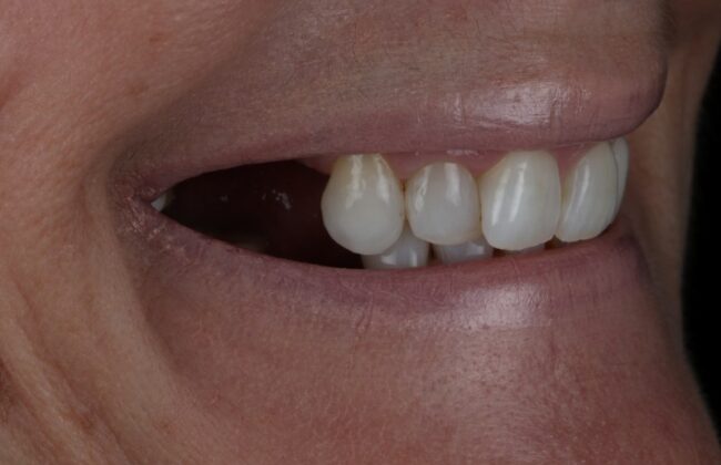 Before (Teeth)