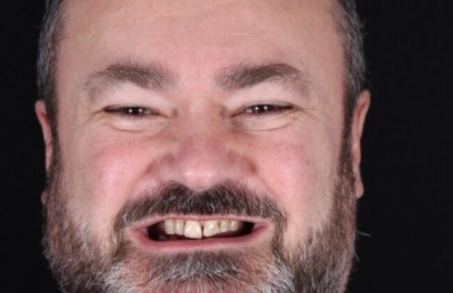 Before (Teeth)