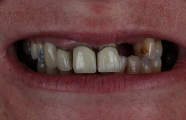 Before (Teeth)